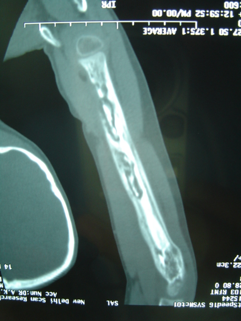 CT Scan Of Infected Bone